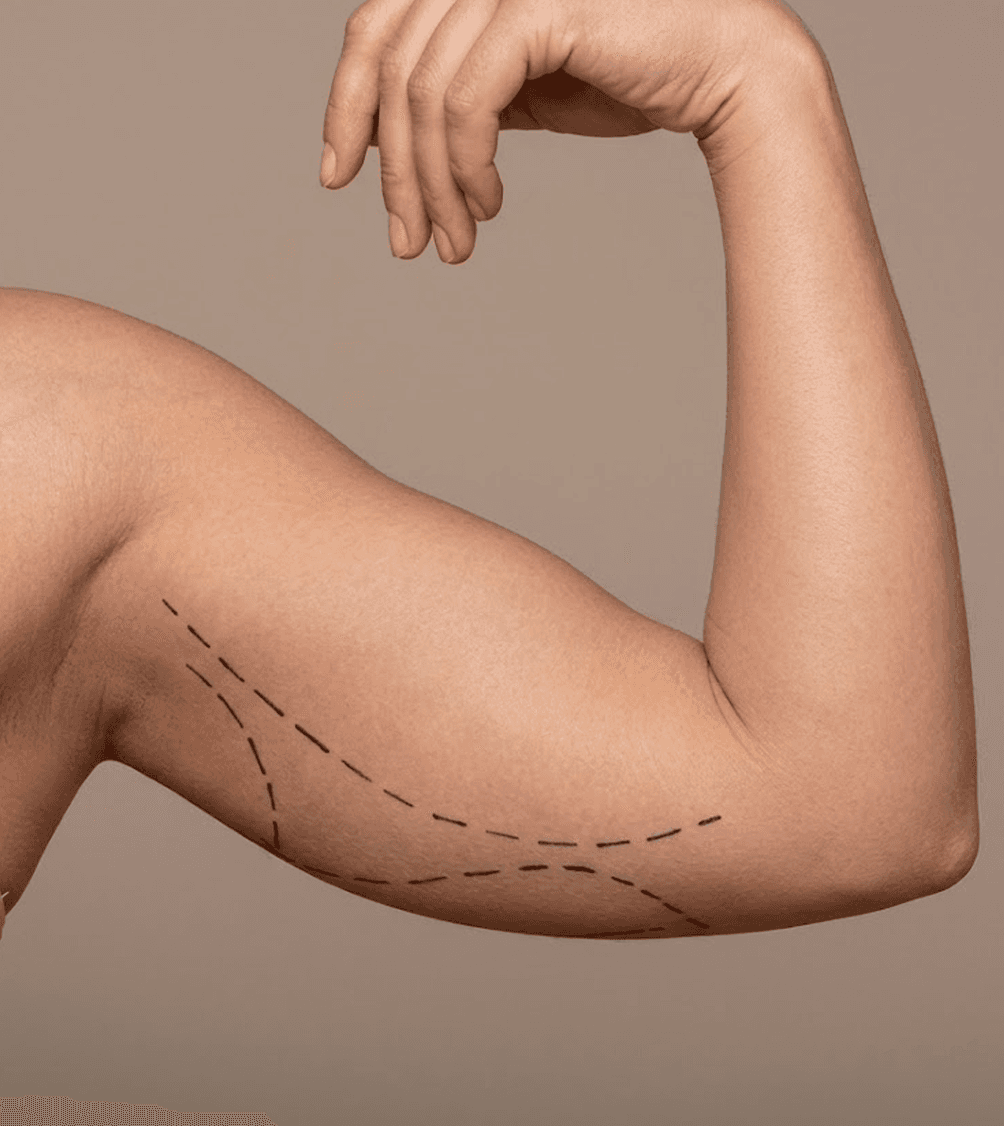 Brachioplasty