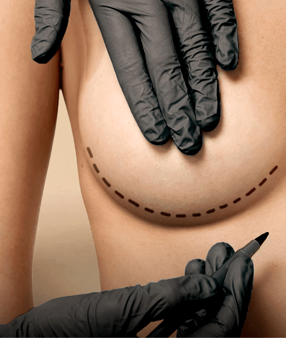Breast Surgery