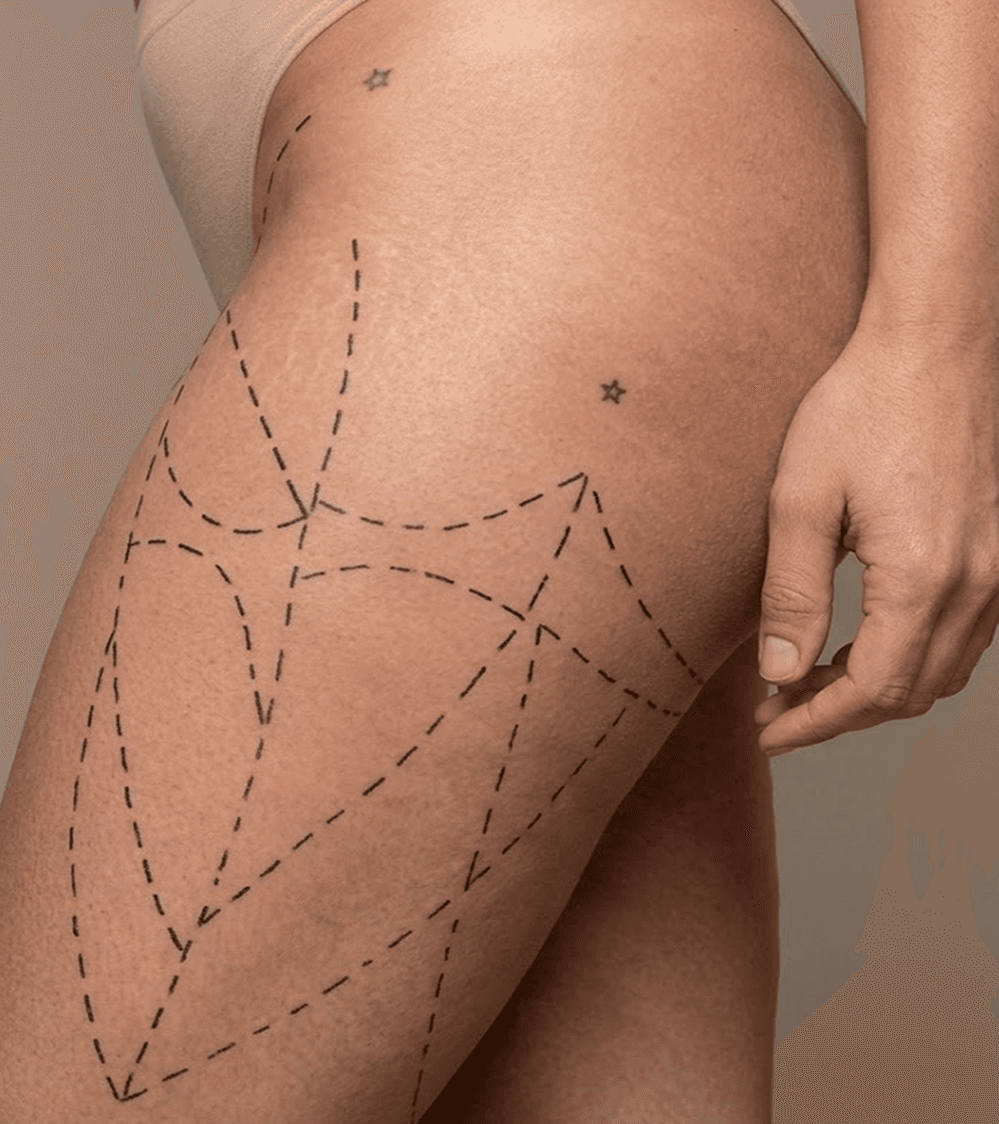 Thigh Lift