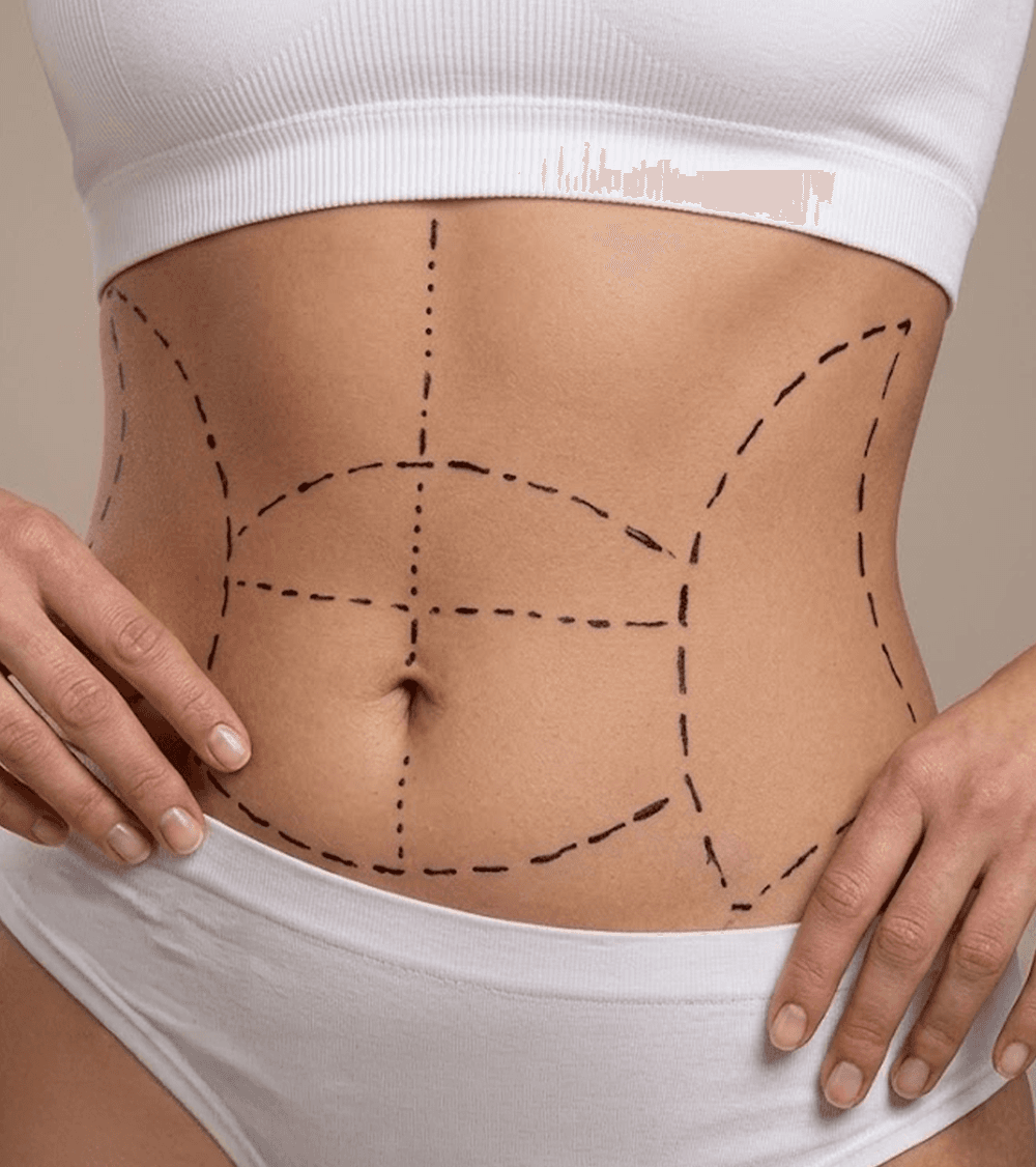 Tummy Tuck